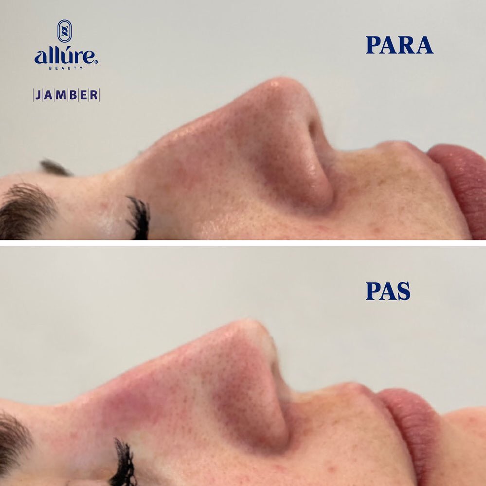 Jamber before and after result, case 25