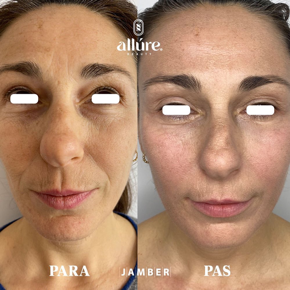 Jamber before and after result, case 24