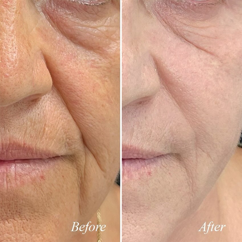 Jamber before and after result, case 23