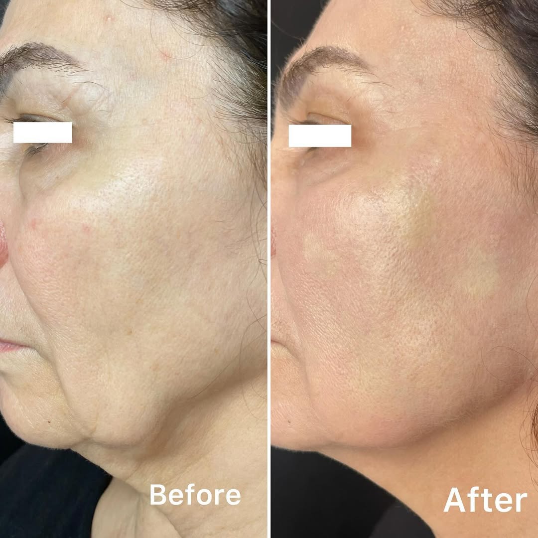 Jamber before and after result, case 22