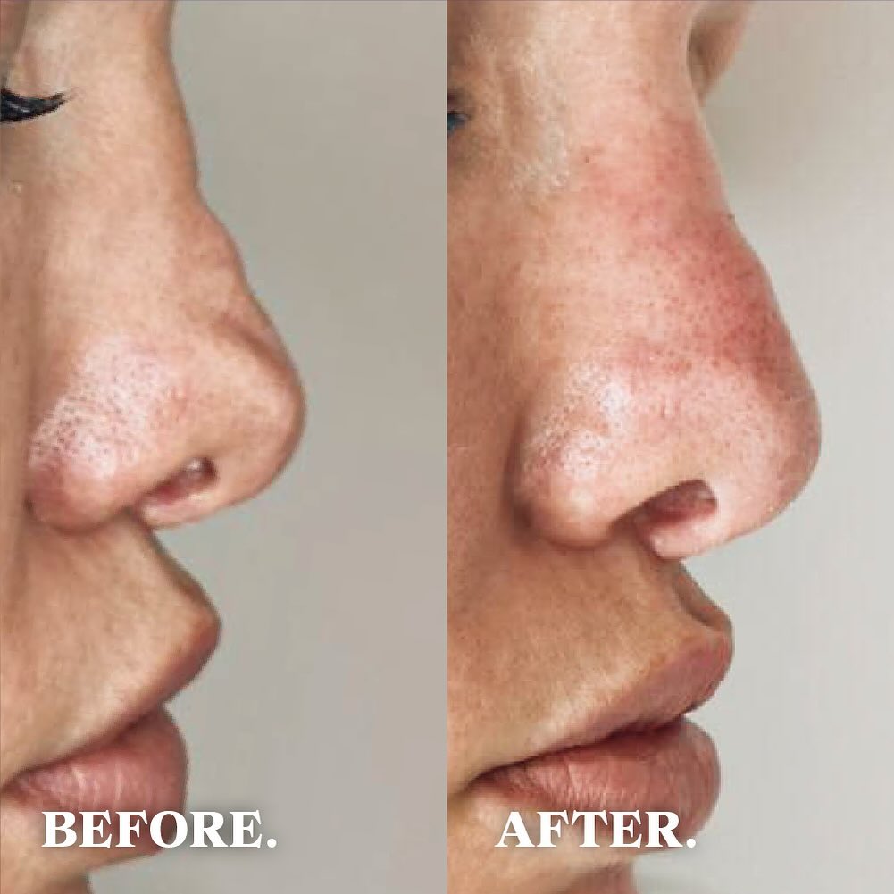 Jamber before and after result, case 20