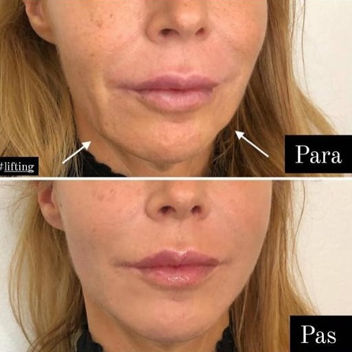 Jamber before and after result, case 18