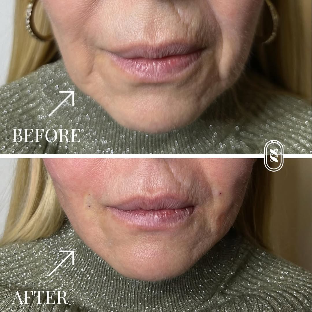 Jamber before and after result, case 17