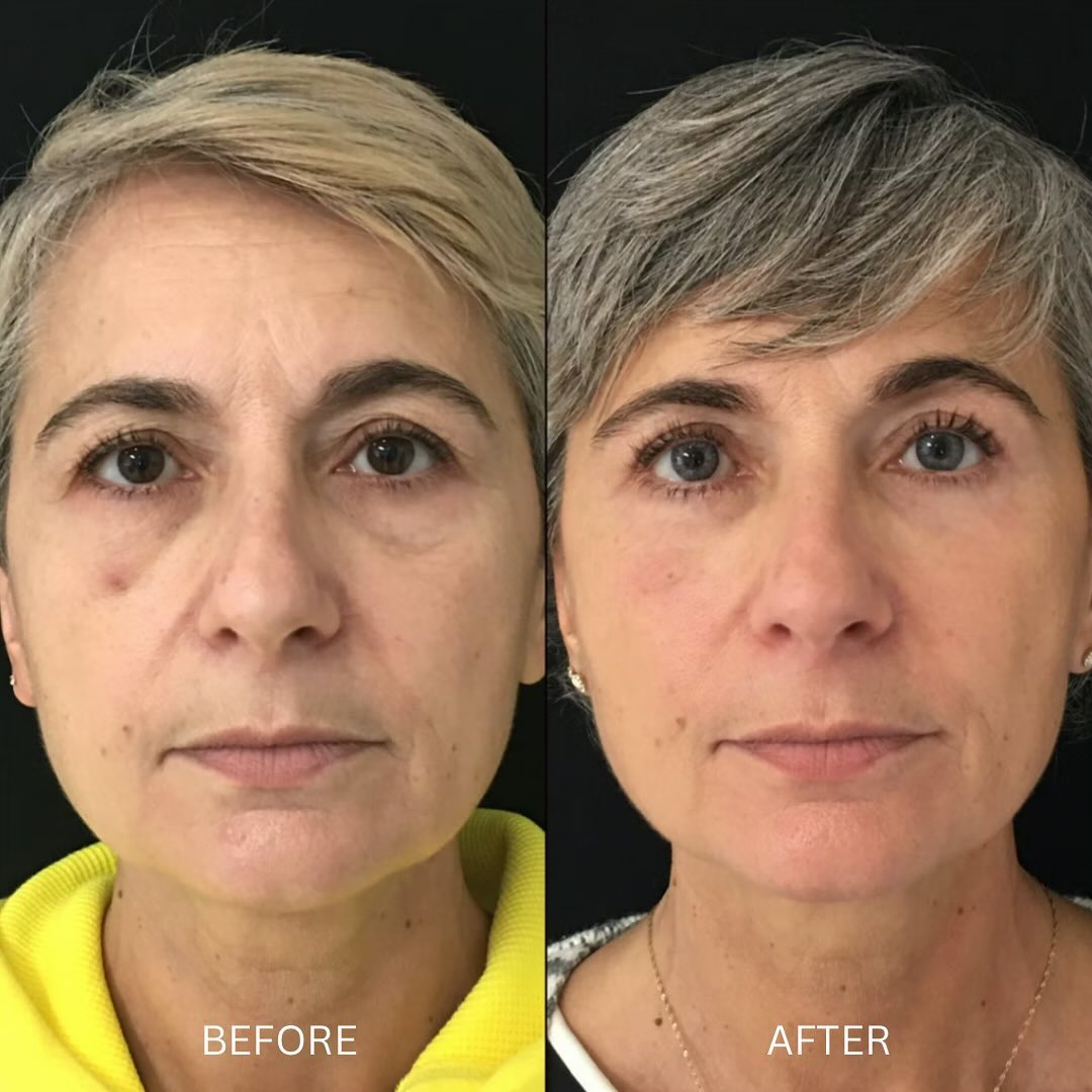 Jamber before and after result, case 14
